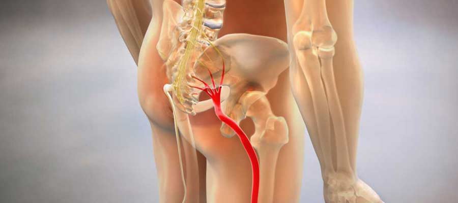 Sciatica Causes, Symptoms and Treatment in San Diego